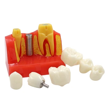 Стоматологичен модул за обучение анализ на импланти Подвижен модел на корони мостовидного протеза Демонстрационен модел на зъбите